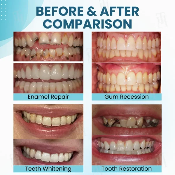 ✅ Recommended by professional dentists🦷 AEXZR® Makesmile Bee Venom Oral Treatment Powder - A one-month supply that eliminates 90% of bacteria that regular brushing can't handle🔥
