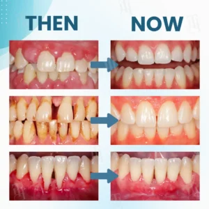 ✅ Recommended by professional dentists🦷 AEXZR® Makesmile Bee Venom Oral Treatment Powder - A one-month supply that eliminates 90% of bacteria that regular brushing can't handle🔥
