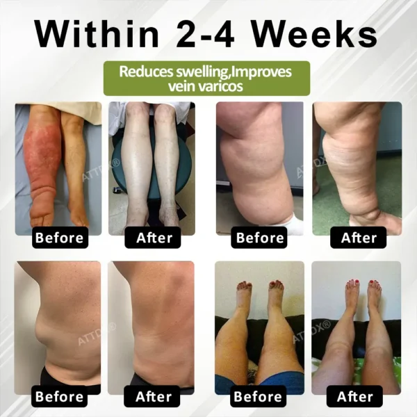 Oveallgo® VeinoRoll Therapy Edema Comfort Cream
