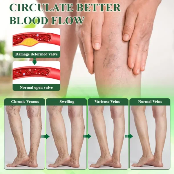Oveallgo® VeinoRoll Therapy Edema Comfort Cream