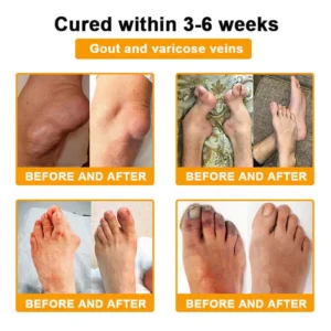 RAINDEW® BEE VENOM LITHOSPERMUM Pain-Relief Bone Healing Cream 👑👑(Specially for older adults)