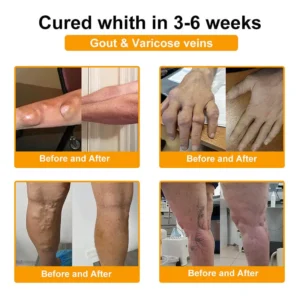 RAINDEW® BEE VENOM LITHOSPERMUM Pain-Relief Bone Healing Cream 👑👑(Specially for older adults)