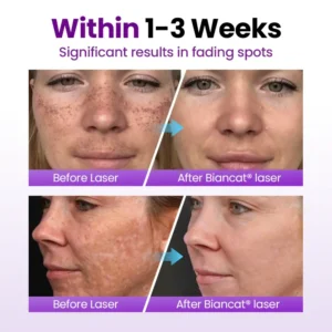 Biancat® SpotErase Probiotic Shield Serum 🇬🇧 XH-SpotErase-upsell