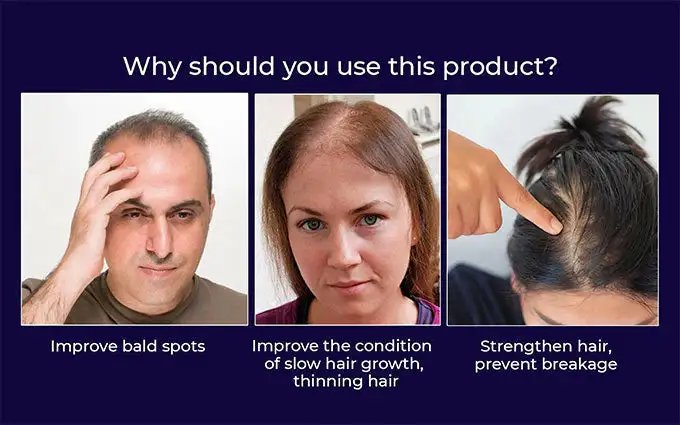 🔥(Last Day SAVE 60% OFF)LOVILDS Natural Hair Regrowth Spray