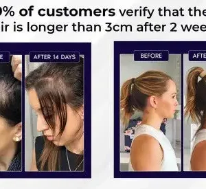 🔥(Last Day SAVE 60% OFF)LOVILDS Natural Hair Regrowth Spray