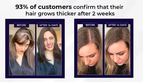 🔥(Last Day SAVE 60% OFF)LOVILDS Natural Hair Regrowth Spray