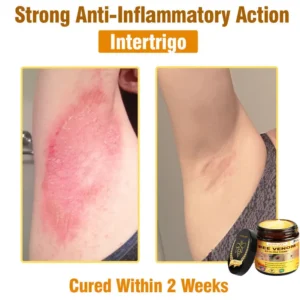 𝐋𝐎𝐕𝐈𝐋𝐃𝐒™ 𝐁𝐞𝐞 𝐕𝐞𝐧𝐨𝐦 𝐀𝐥𝐥-𝐢𝐧-𝐎𝐧𝐞 𝐂𝐫𝐞𝐚𝐦–🌸 Anti-aging,Hydrating, Skin Repair, Even Tone, Acne and Dark Spot Treatment, Wart and Mole Removal, Psoriasis Relief