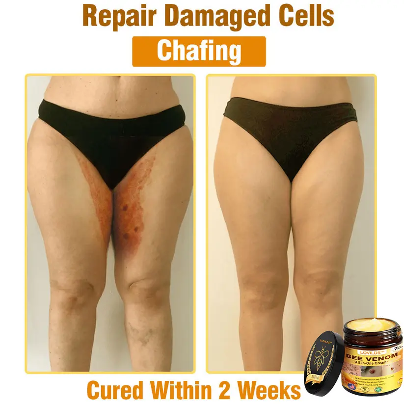 𝐋𝐎𝐕𝐈𝐋𝐃𝐒™ 𝐁𝐞𝐞 𝐕𝐞𝐧𝐨𝐦 𝐀𝐥𝐥-𝐢𝐧-𝐎𝐧𝐞 𝐂𝐫𝐞𝐚𝐦–🌸 Anti-aging,Hydrating, Skin Repair, Even Tone, Acne and Dark Spot Treatment, Wart and Mole Removal, Psoriasis Relief