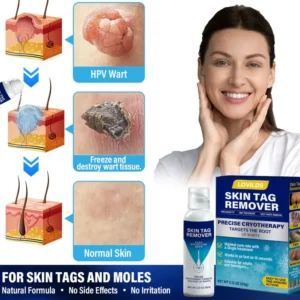 LOVILDS®  Cryo Treatment Spray Effortlessly remove skin tags and warts-no pain