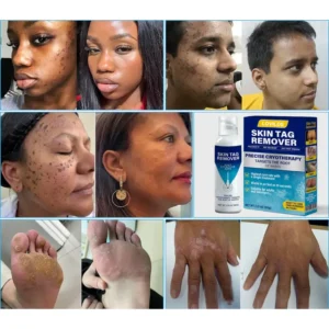 LOVILDS®  Cryo Treatment Spray Effortlessly remove skin tags and warts-no pain