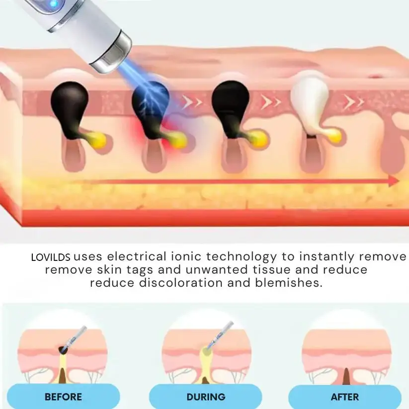 🔥【OFFICIAL STORE】LOVILDS™ Non-Invasive Mole and Wart Removal Laser Pen