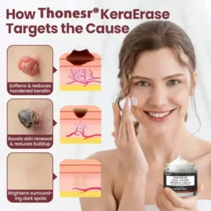 Thonesr® KeraErase Dual-Action Renewal Cream
