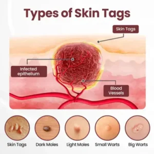 Thonesr® KeraErase Dual-Action Renewal Cream