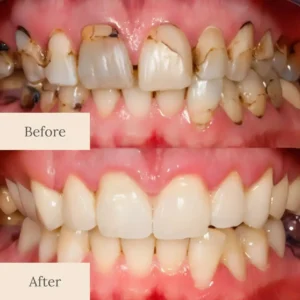 Limited-Time Pre-Sale⏰LOVILDS™ Teeth Armor Drops