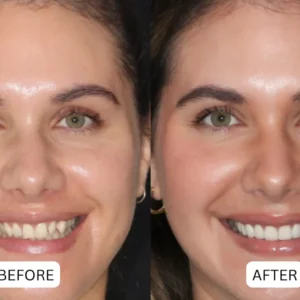 Limited-Time Pre-Sale⏰LOVILDS™ Teeth Armor Drops