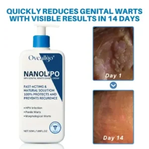Oveallgo® NanoLipo HPV Genital Warts Eraser Cream Ultra