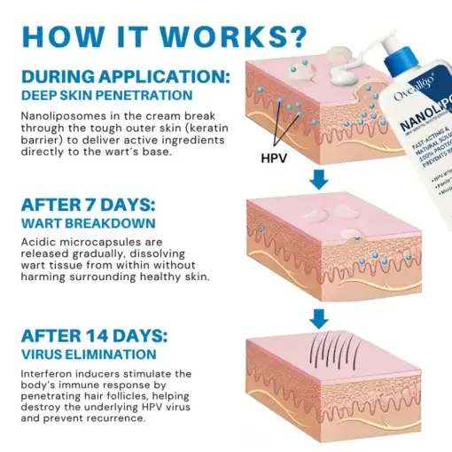 Oveallgo® NanoLipo HPV Genital Warts Eraser Cream Ultra