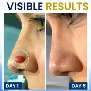 AEXZR® Skin Tag Cryo Treatment Spray Precision Cryo-Tech Freezes Away Skin Tags Warts in Seconds No Blades, No Pain.