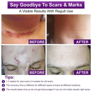 Cougex® Stem Cell Scar Gel –❤️Treats old and new scars, helps reduce the appearance of scars from acne, surgery, burns, injuries, and stretch marks