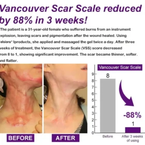 Cougex® Stem Cell Scar Gel –❤️Treats old and new scars, helps reduce the appearance of scars from acne, surgery, burns, injuries, and stretch marks