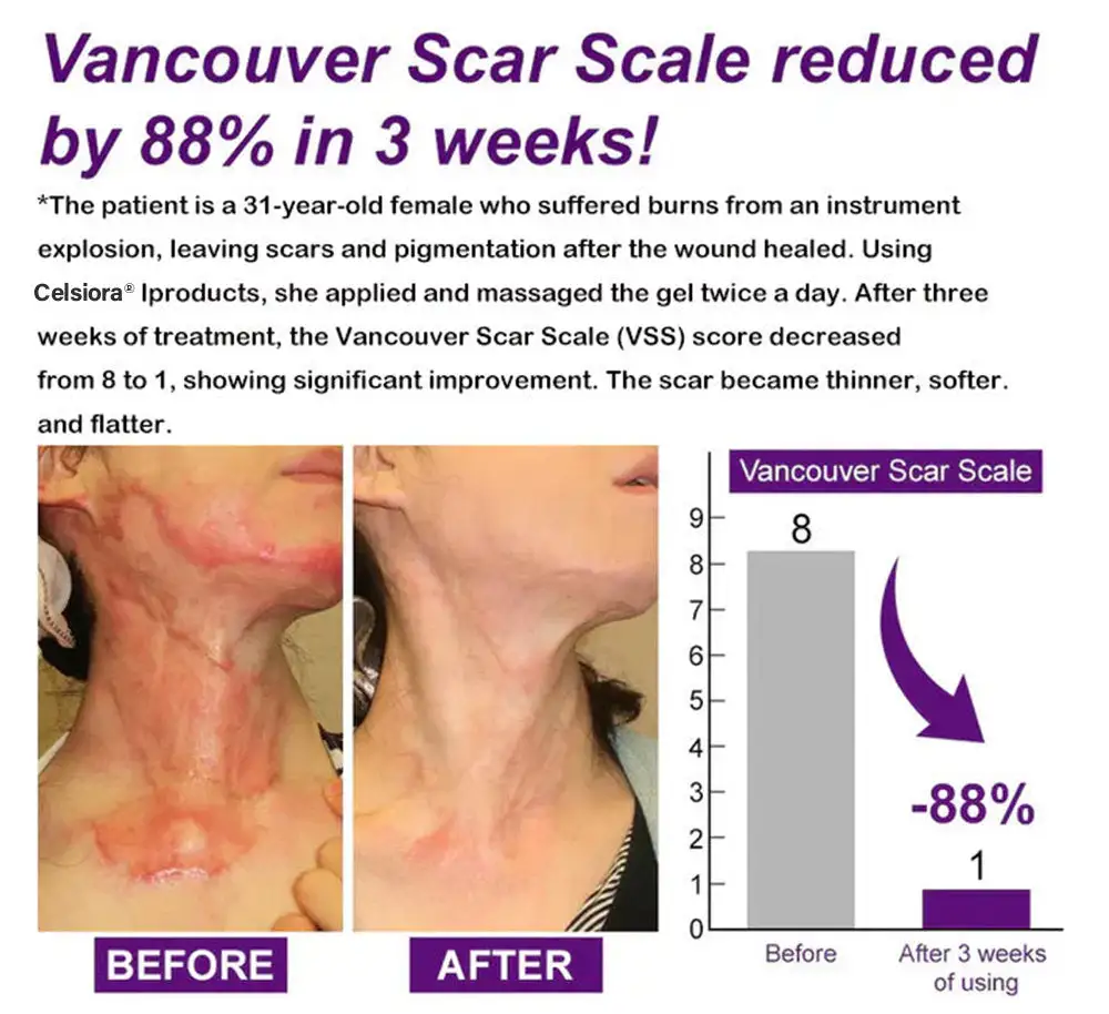 Cougex® Stem Cell Scar Gel –❤️Treats old and new scars, helps reduce the appearance of scars from acne, surgery, burns, injuries, and stretch marks