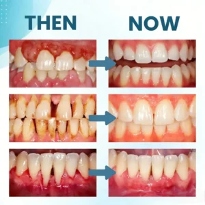 🔥Final 3 Hours: 80% OFF - 🐝ODALIT® Smilewell Bee Venom Oral Care Powder🦷