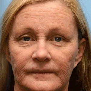 [🥇Last Day 70% OFF] ODALIT™ Botox & Retinol Shot - Eraser for Deep Wrinkles, Sagging Jowls & Puffy Eyes