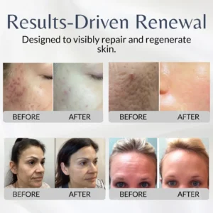 Professional Microneedling Results Without the Medical Bill: AEXZR® Cellular Renewal System.